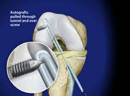An acl surgery requires precise knowledge of the anatomy of the knee, attachment sites of the acl and knowledge on the other ligaments and structures of the knee. Anterior Cruciate Ligament Acl Reconstruction Following Rupture Joint Surgeon Com