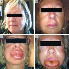 Image result for Angioedema