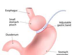 Gastric Bands How It Works Surgery Who Should Have It