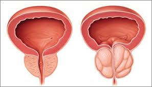 Prostate Symptoms Bladder Outlet Obstruction The British