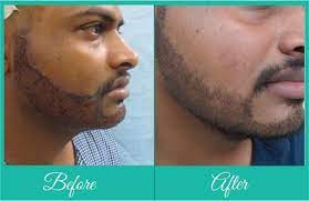 Dr.sunil arora, one of the most renowned hair transplant specialists, has been offering successful facial hair transplant in jaipur. Beard Transplant Are They Really Worth The Cost