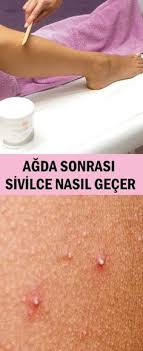 Agda Sonrasi Sivilce Nasil Gecer Cilt Bakimi Dogal Saglik Populer Pinler