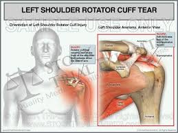 Rotator Cuff Tear Injury Of Left Shoulder Male Orientation Rotator Cuff Tear Rotator Cuff Rotator Cuff Injury