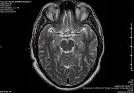 Image result for Neurosyphilis