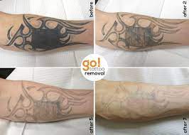 Go Tattoo Removal Tattoo Removal Cost Tattoo Removal Original Tattoos