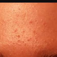 2 Jahre Kleine Pickel An Der Stirn Gesicht Creme Maske