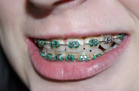 Periksa kandungan di klinik kerajaan malaysia itu gratis! Ngeri Wanita Ini Alami Demam Hingga Bibirnya Bengkak Gara Gara Behel Palsu