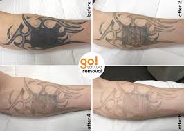 This Client Started With Us About A Year Ago They Had Their Original Tattoo Covered Up And Weren T Pleased Tattoo Removal Cost Original Tattoos Tattoo Removal