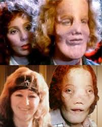 The real Florence "Rusty" Tullis & Rocky Dennis bottom picture (1970's)