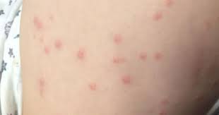 It was first identified in december 2019 in wuhan,. Mum Who Battled Coronavirus Has Warning For Parents Over Child S Rash Liverpool Echo