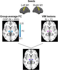 Image result for Thalamotomy