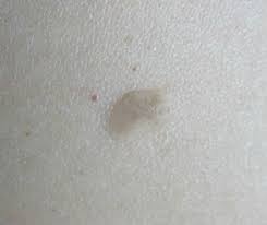 Manchas Marrones Y Rugosas Por El Cuerpo Doctora Lorea Bagazgoitia