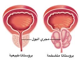 علاقة احتقان البروستاتا والعادة السرية المرسال