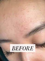 How long does fungal acne last? Redditor Shares Transformative Fungal Acne Routine See Her Before After Photos Allure