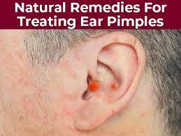 10 Effective Natural Remedies For Treating Ear Pimples Boldsky Com