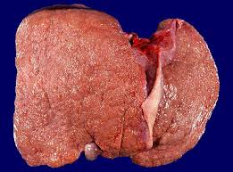Cirrhosis of the liver pictures. Webpathology Com A Collection Of Surgical Pathology Images