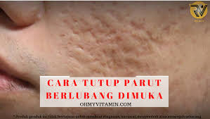 Cara hilangkan parut jerawat 1. Cara Tutup Parut Berlubang Dimuka Coach Bisnes Coach Detox Kurus Coach Penyusuan Susu Ibu Mentor Bisnes Pengedar Shaklee Pengedar Youth Pengedar Vivix 011 17547669