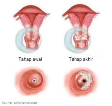 Wajar saja karena menurut data who (badan kesehatan dunia), penyakit kanker serviks ini menempati peringkat teratas penyebab. Kanker Serviks The Sillent Killer Lippoinsurance