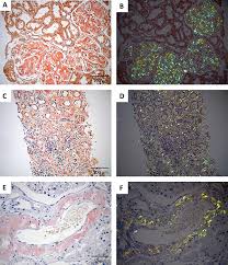 Treatment goal in patients with aa amyloidosis is a complete control of the inflammatory process 6. Correlation Between Amyloid Deposits Affecting Renal Compartments And Glomerular Filtration Rate During Renal Biopsy In A Renal Amyloidosis Case Series