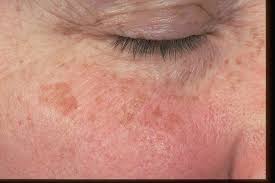 Image result for Solar Lentigo