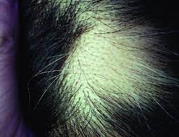 These patches may connect, however, and then become noticeable. Case 3 A Round Well Defined Patch Of Hair Loss On The Scalp With A Download Scientific Diagram