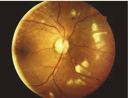 Image result for HIV Retinitis