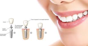 It must not only focus on the outer aspects of a smile, such as the teeth. Zahnimplantate Dentist Ozan Guner For A Better Smile