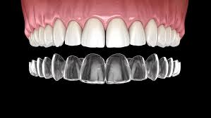 =data on file at align technology, as of march 31, 2021. Invisalign Cost Omega Dental Houston Tx