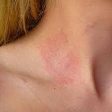 Image result for contact dermatitis