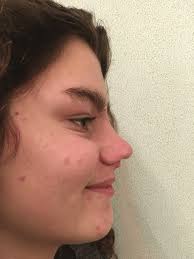 preoperative lateral view with a total absence of distal half of the...