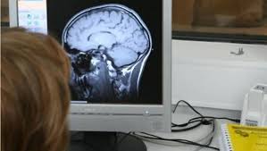 Stwardnienie rozsiane (w skrócie, wywodzącym się od angielskiej nazwy multiple sclerosis, określane jako sm lub ms) to choroba o podłożu. Stwardnienie Rozsiane Objawy I Skuteczna Walka Z Choroba Uroda I Zdrowie Serwis Nie Tylko Dla Kobiet