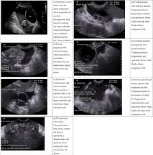 Ultrasound features of various kinds of ascites in women. (a)...