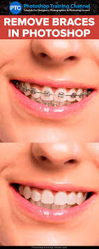 In fact, a huge number of adults are hopping on the braces bandwagon to get the grin they've always wanted. How To Get Braces For Free Arxiusarquitectura