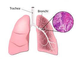 Image result for Lung Cancer