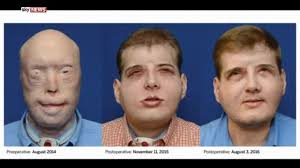 Fireman Celebrates Face Transplant