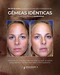 ✨ Você sabia que até gêmeas idênticas podem ter trajetórias diferentes no  envelhecimento da pele? O uso do botox ao longo dos anos ajuda a suavizar  rugas, manter a firmeza e garantir