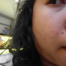 Maybe you would like to learn more about one of these? Review Nyobain Treatment Acne Facial Bio Light Therapy Dari Naava Green Duckofyork Indonesian Lifestyle Blogger