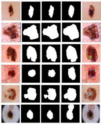 In the united states, it's estimated that doctors diagnose over 100,000 new skin cancer cases each year. Https Arxiv Org Pdf 1904 11126