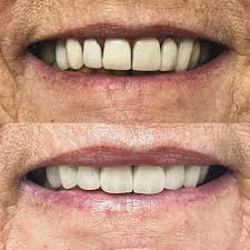 Thinking about a SMILE MAKEOVER? Let's talk! Veneers and smile ...