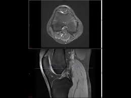 Magnetic resonance imaging (mri) interpretation of the knee is often a daunting challenge to the student or physician in training. Knee Mri Approach To Msk Mri Series Youtube