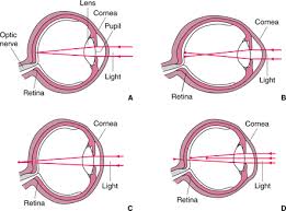 Image result for Refractive Error