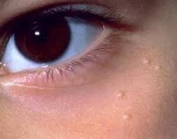 как избавиться от белых пятен на лице в домашних условиях Izbavitsya Ot Belyh Tochek Na Lice Mozhno Ochen Prosto Vot 5 Samyh Effektivnyh Naturalnyh Receptov Beauty Skin Care Skin Beauty Regimen