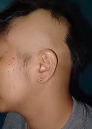 These cases of lupus are caused by certain medications. Alopecias In Lupus Erythematosus Lupus Science Medicine