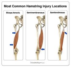 Injury to the achilles tendon causes pain along the back of your leg near the heel. Tendinopathy Of The Hamstring