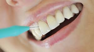 They are thin dental material coverings that go directly over a tooth to hide imperfections. What S The Easiest Way To Clean Between Your Teeth