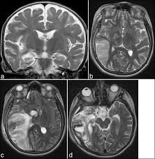 • restriction on diffusion weight mri = more sensitive than conventional sequences. Herpes Simplex Encephalitis As A Complication Of Neurosurgical Procedures Report Of 3 Cases And Review Of The Literature Virology Journal Full Text