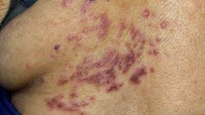 Image result for zoster under breasts