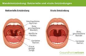 Mandelentzundung Ursachen Symptome Diagnose Behandlung