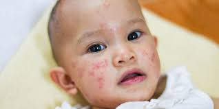 Prinsip pemeriksaan pada bayi baru lahir jelaskan prosedur pada orang tua dan minta persetujuan tindakan cuci dan keringkan tangan , pakai sarung tangan pastikan pencahayaan bayi dengan edema otak atau tekanan intrakranial meninggi seringkali lidahnya keluar masuk (tanda foote). 13 Penyebab Bintik Merah Pada Kulit Bayi Dan Perawatannya