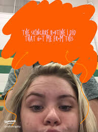 How Effective is AHA 30% + BHA 2% Exfoliating Peeling Solution?